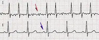 Afib ecg