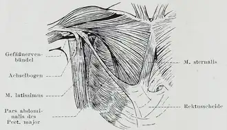 An individual with an abdominal portion of the pectoralis major, and an accessory sternalis muscle. Both these are anatomical variations.
