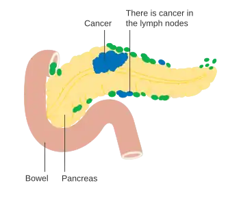 Pancreatic cancer in nearby lymph nodes – Stage N1