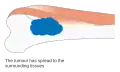 Stage 2B bone cancer