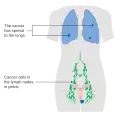 Stage 4B vulvar cancer