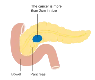 Stage T2 pancreatic cancer