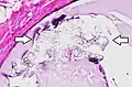 Histopathology of calcium oxalate crystals in a benign breast cyst, H&E stain. In the breast, they can be seen on mammography and are usually benign, but can be associated with lobular carcinoma in situ.[13]