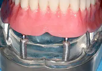 Implant retained overdenture