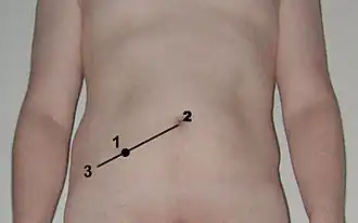 Location of McBurney's point (1), which is located two thirds the distance from the umbilicus (2) to the anterior superior iliac spine (3)