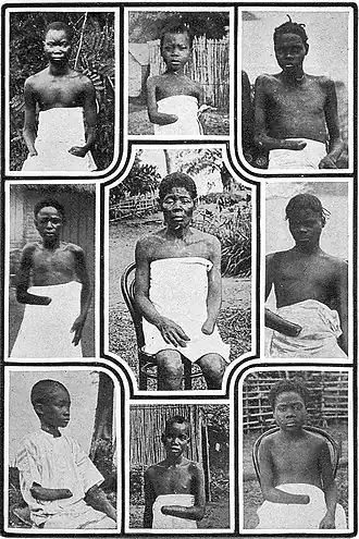 Collage of mutilated Congolese published in King Leopold's Soliloquy. Often credited to Alice Harris, biographer Óli Jacobsen argues that all of these were taken by Danielsen.[6]