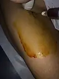 PRP is Injected into area of injury via ultrasound guidance
