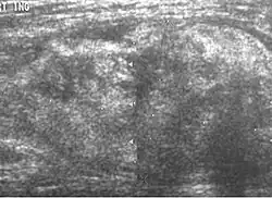 Ultrasonography of a liposarcoma for comparison: In this case a heterogeneous mass consisting of an upper hyperechoic portion, corresponding to lipomatous matrix, and areas of hypoechogenicity corresponding to nonlipomatous components.[24]