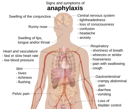 Signs and symptoms of anaphylaxis