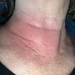 Erythema migrans ("migrating redness") on a woman's neck. Rashes from non-Lyme causes may look similar.