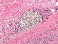 Foreign-body giant cell reaction to a suture. H&E stain.