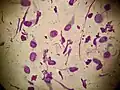 Tadpole cells on a smear taken from a patient with allergic contact dermatitis (May-Grünwald Giemsa x1000).