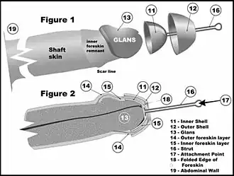 Application of a typical restoration device, the TugAhoy, called a 'Chinese puzzle' by its inventor