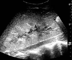 Renal ultrasonograph in renal failure after surgery with increased cortical echogenicity and kidney size. Biopsy showed acute tubular necrosis.[20]