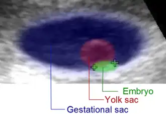 Artificially colored, showing gestational sac, yolk sac and embryo (measuring 3&nbsp;mm as the distance between the + signs)