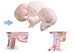 An animated image showing the mechanisms of whiplash