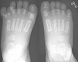 Right-sided duplication of the right little toe in an 8.5 months old male, with two toes (fifth and sixth) apparently forming joints with the fifth metatarsal bone, which is mildly broadened distally. The duplicated toes have almost normal growth. The fifth toe has mild varus angulation, and the sixth toe has substantial valgus angulation.